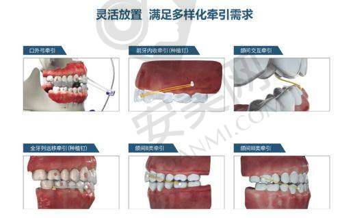 正雅隐形矫正9999元起：性价比之选
