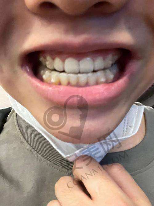 潘少群医生：正雅隐形矫正的骨干医生
