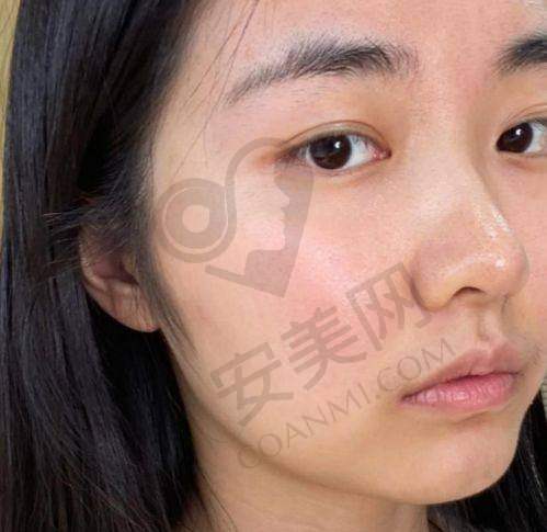 光子嫩肤治疗的过程是怎样的？