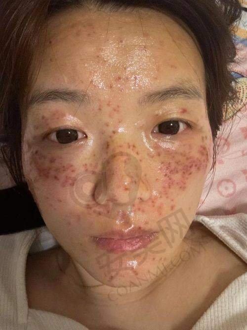 北京超皮秒祛斑的价格大概是多少？