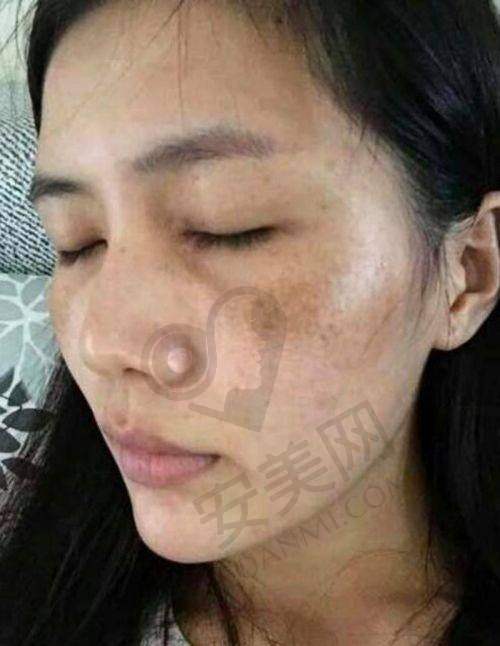 北京超皮秒祛斑的市场现状如何？