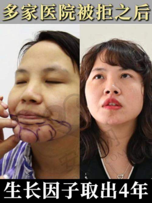 子因子修复项目的治疗过程是怎样的？