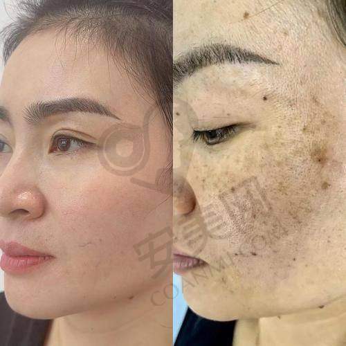 北京美莱超皮秒祛斑的治疗过程是怎样的？