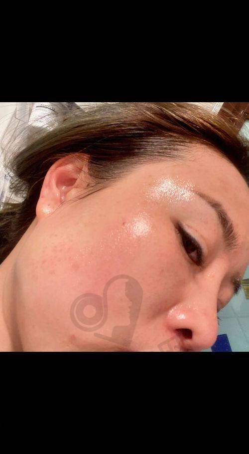 北京美莱超皮秒祛斑后需要注意什么？