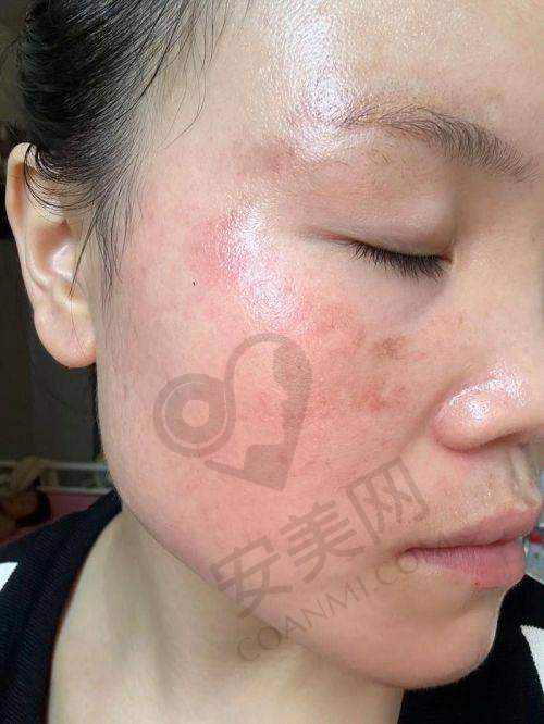 北京美莱超皮秒祛斑的成效显著吗？