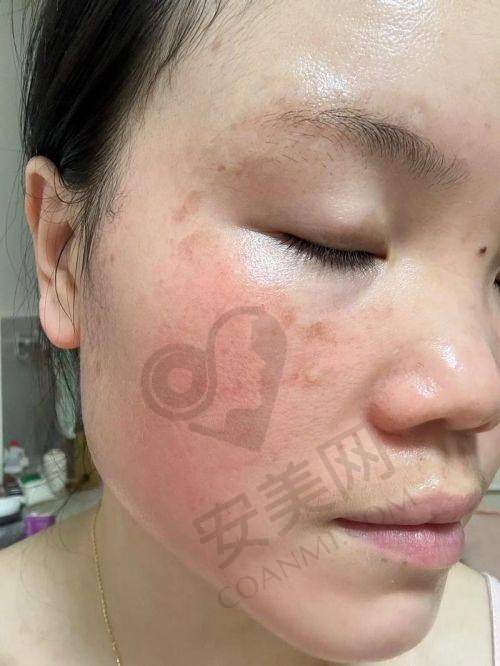 超皮秒祛斑后需要注意什么？