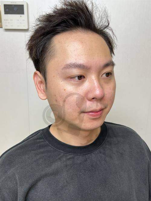 半岛黄金微针4.0全方面部体验的过程是怎样的？