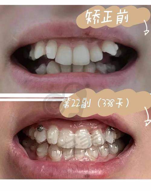 为什么选择深圳新安麦芽口腔进行牙齿隐形矫正？
