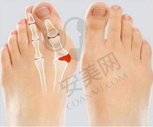 五代热玛吉治疗过程是怎样的？
