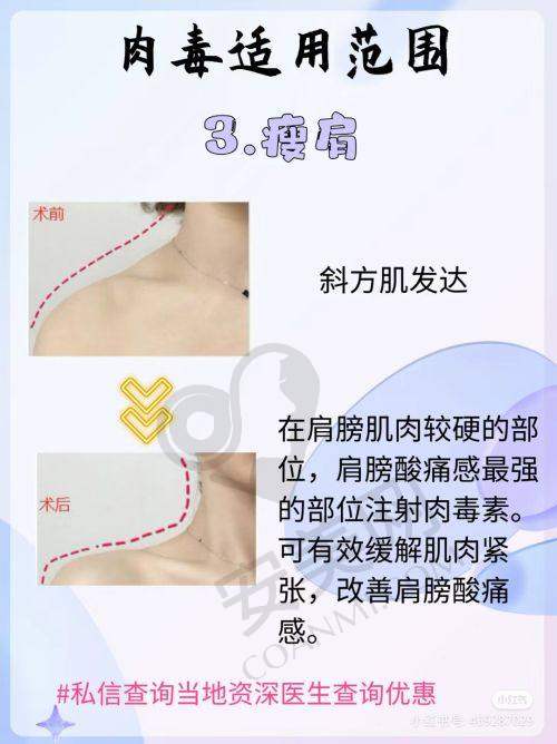 济南诺德的五代热玛吉与其他医院有何不同？