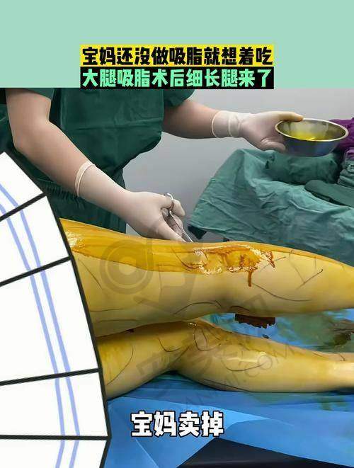 武汉仁爱时光整形医院大腿吸脂技术有什么特色？