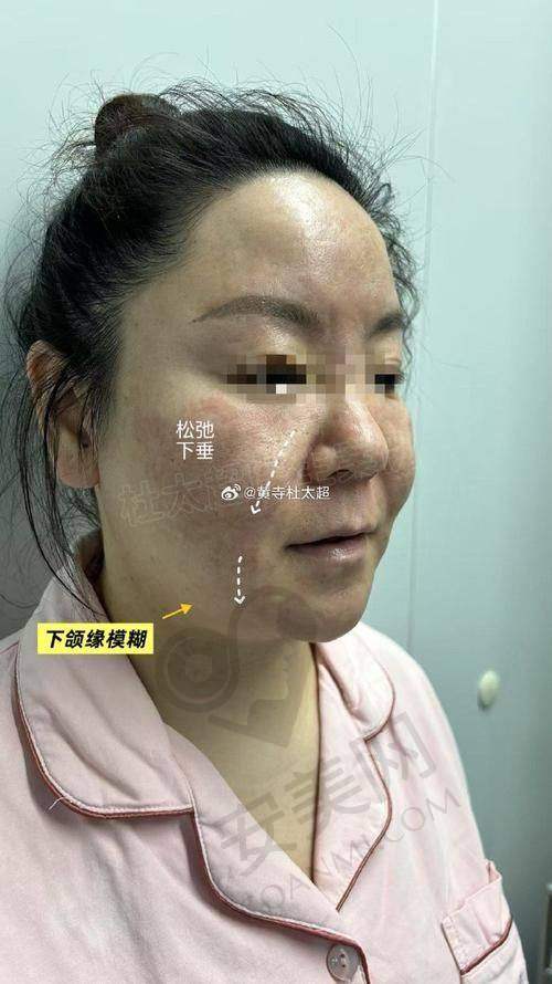 闫立新医生面部提升的成效如何?