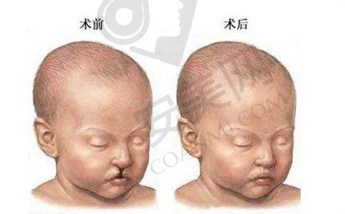 植发术后注意事项
