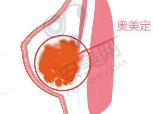 北京煤医西坝河医疗美容医院：取出修复抑制同步，全方面保护