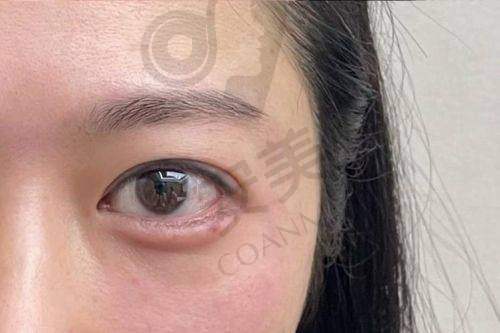 为什么选择北京艺星进行玻尿酸填充泪沟？
