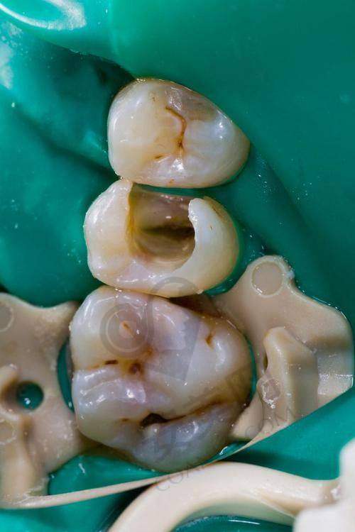 衡阳优牙仕口腔医院牙齿根管治疗的价格是如何确定的？