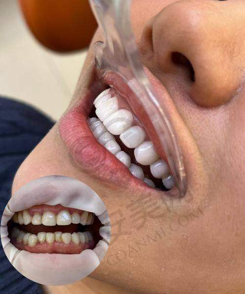 贴面粘贴：见证牙齿蜕变的时刻？
