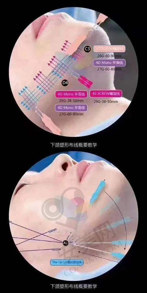 埋线提升价格究竟几何？