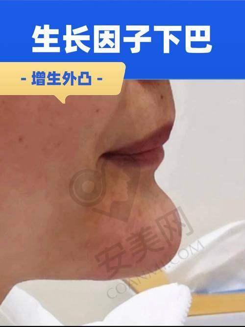 医疗美容：3D内窥镜微创，效率高干净的典范