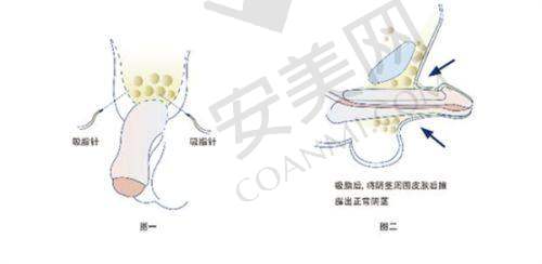 耳软骨隆鼻术后护理要点