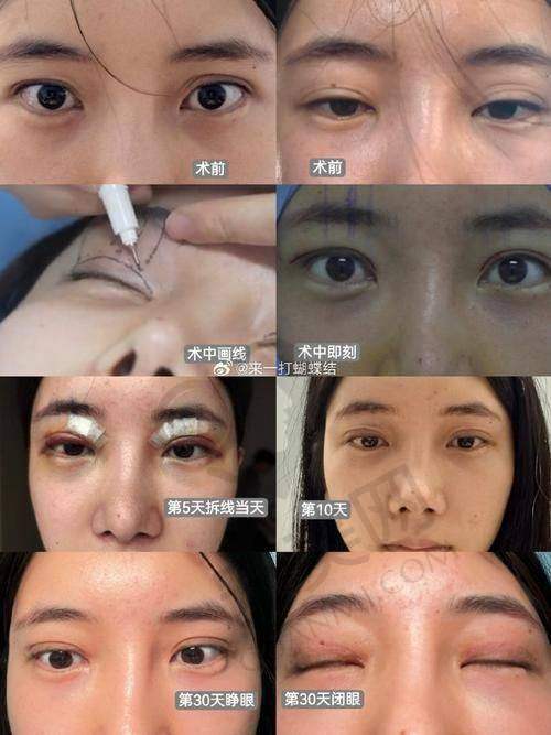 武汉美莱眼综合手术，究竟有何独特之处？