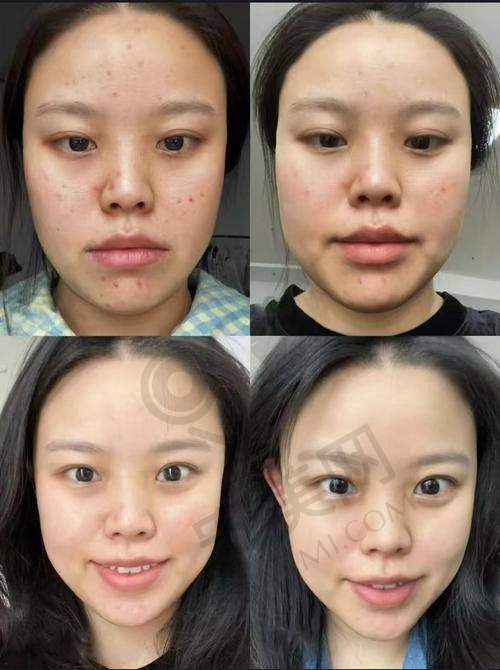 黄金微针5.0治疗过程是怎样的？