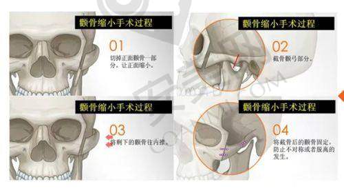 3、武汉紫荆项昌峰医生整形技术怎么样？