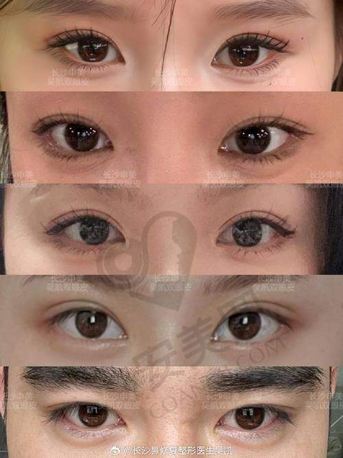 选择南京艺星汪树杰医生双眼皮整形的理由是什么？