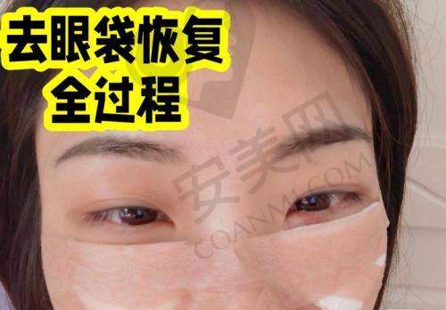 零袋玉眼袋项目有哪些优势？