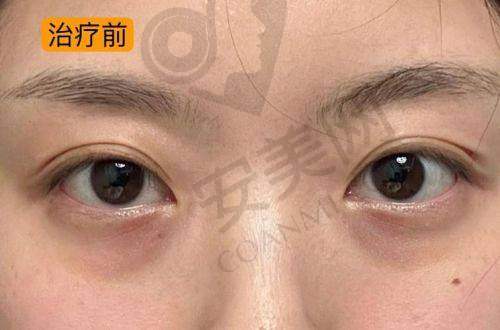 零袋玉眼袋项目的治疗原理是怎样的？