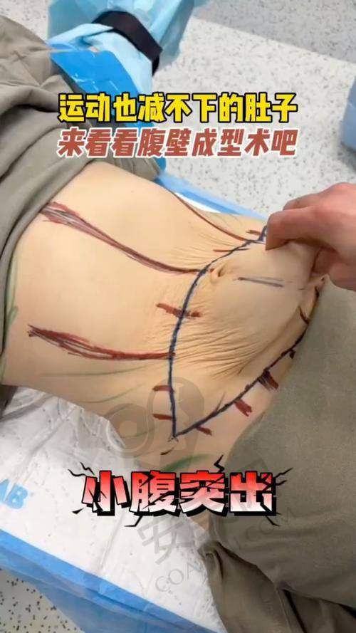 成都李献和医生做腹壁整形手术的技术特色有哪些？