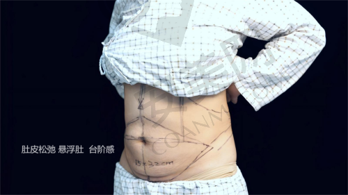 显微腹壁成形术的手术过程是怎样的？