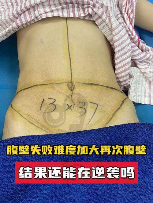 选择李献和医生进行腹壁成形术有哪些优势?