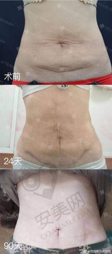 术后成效与修复注意事项
