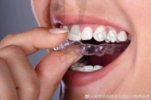 牙齿隐形矫正器戴上后感觉如何？