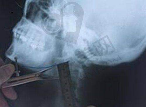 上海首尔丽格朴兴植医生磨骨技术怎么样？揭秘其精湛磨骨技艺与众多成功案例背后的秘诀 