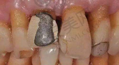 680元的烤瓷牙质量有保护吗？