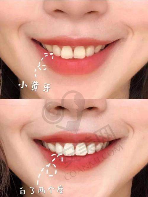 牙齿冷光美白后成效如何?