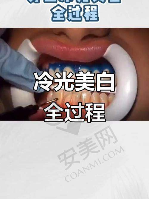 牙齿冷光美白过程是怎样的?