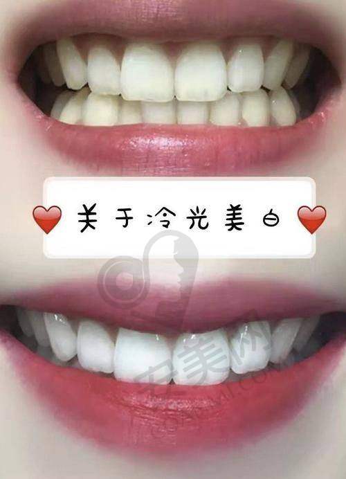 牙齿冷光美白前要做哪些准备?