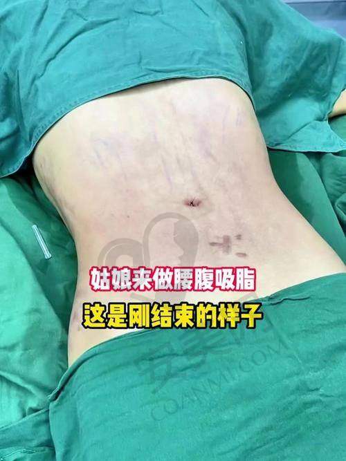 腰腹环吸的价格是如何分阶的？