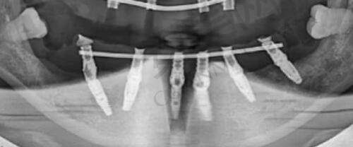 重庆军美玻尿酸注射抗衰的过程是怎样的?