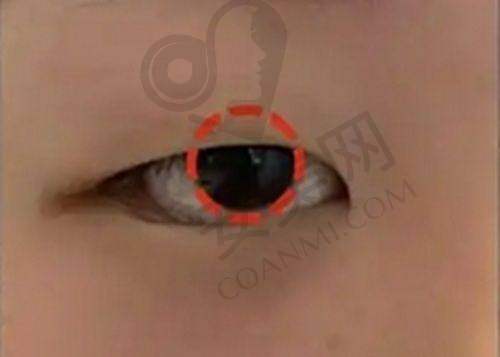 重庆军美玻尿酸注射抗衰和其他抗衰方法相比有什么优势?