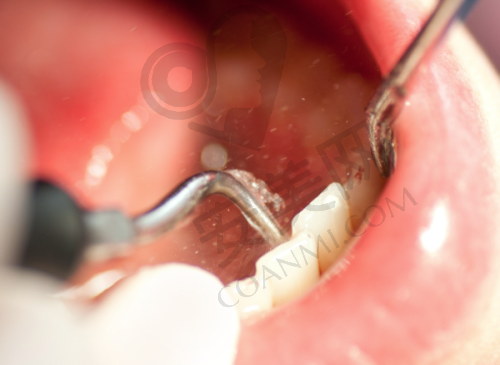 为什么选择石家庄牙博士口腔医院进行牙齿根管治疗?