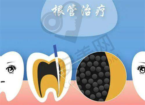 牙齿根管治疗前的检查是怎样的?