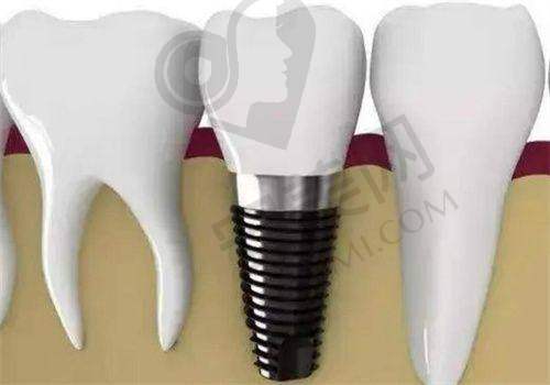 2、仙桃源博士口腔陈亮医生种植牙怎么样?