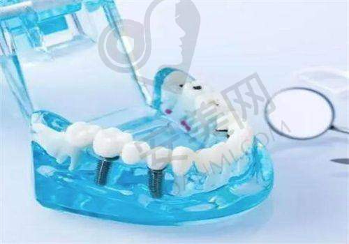 2、重庆名博士口腔门诊部叶金平医生种植牙怎么样?