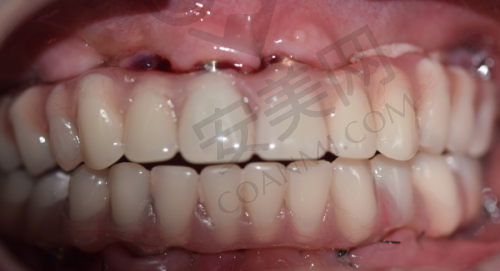 5、乌鲁木齐天使口腔杜旺医生患者评价：