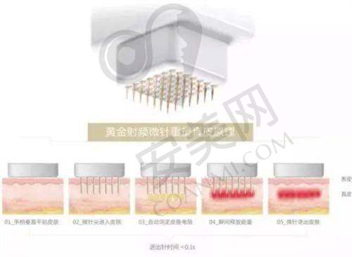 安心性与术后护理:保护美丽的同时呵护肌肤