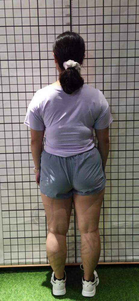 北京画美整形:科技减脂助力效率高塑形